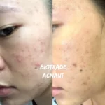 Hình ảnh Thực Tế Review Combo Giảm Mụn Viêm Mủ Biotrade Acnaut - 1Mall.vn